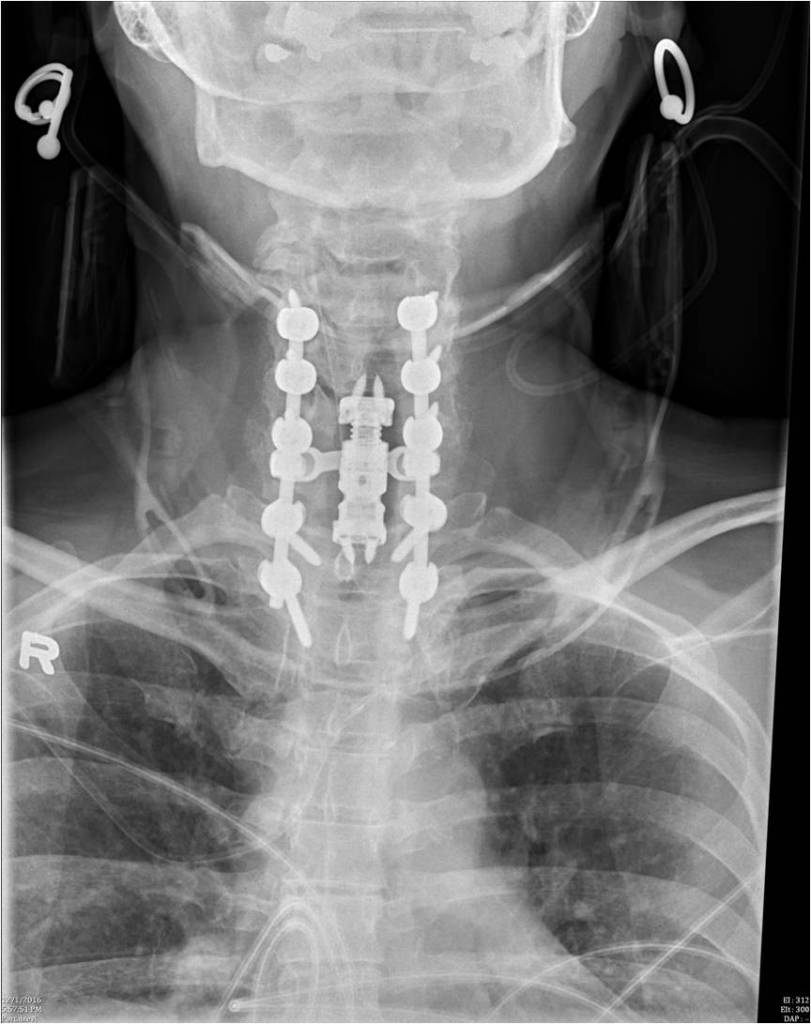 Spinex